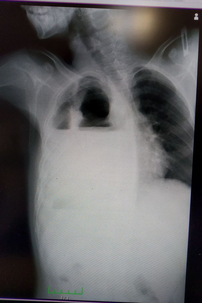 parapnomic pleural effusion
