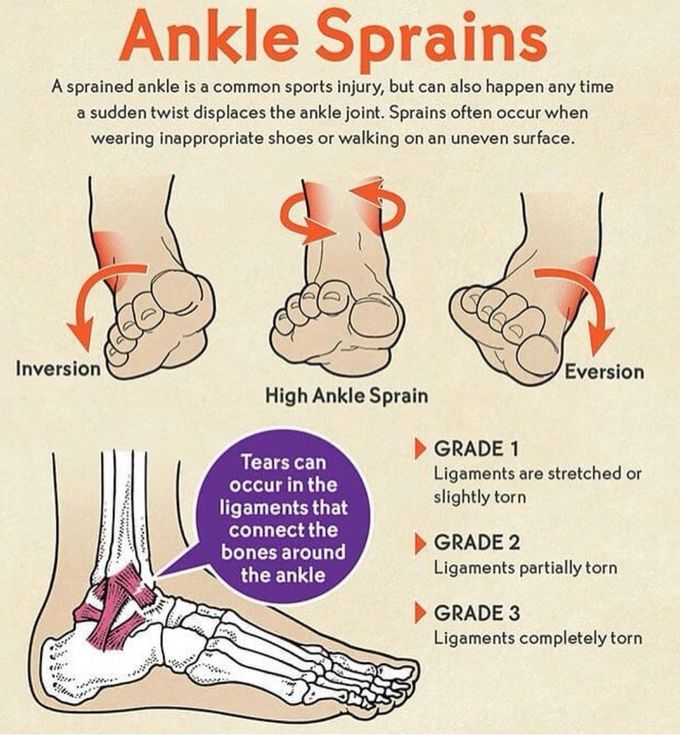 Ankle Sprains