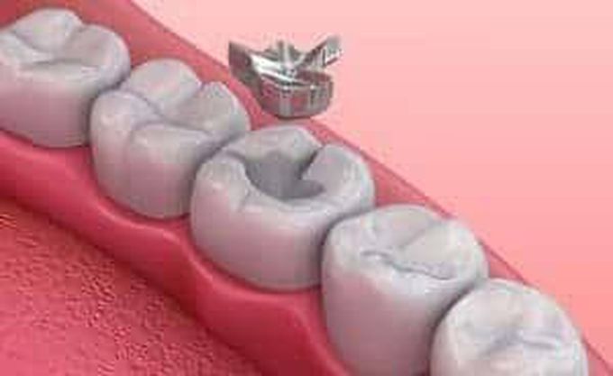 Dislodged tooth filling - MEDizzy