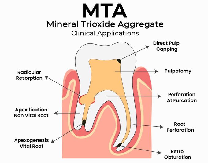 Dental Material- MTA