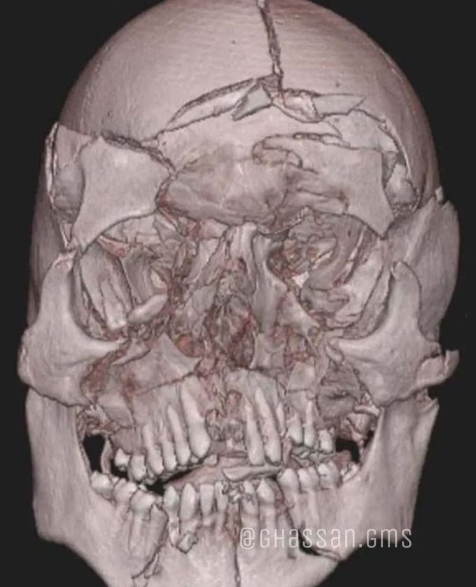 CT of a man who fell from height