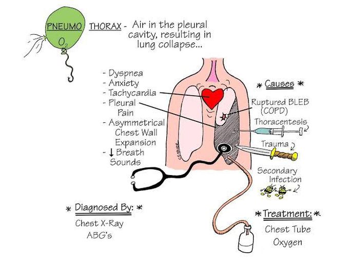 Pneumothorax