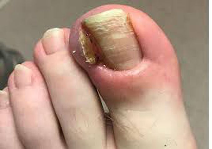 What is ingrown toenail