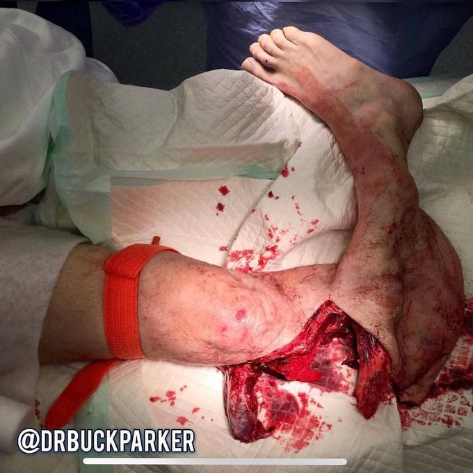 Bicycle accident 