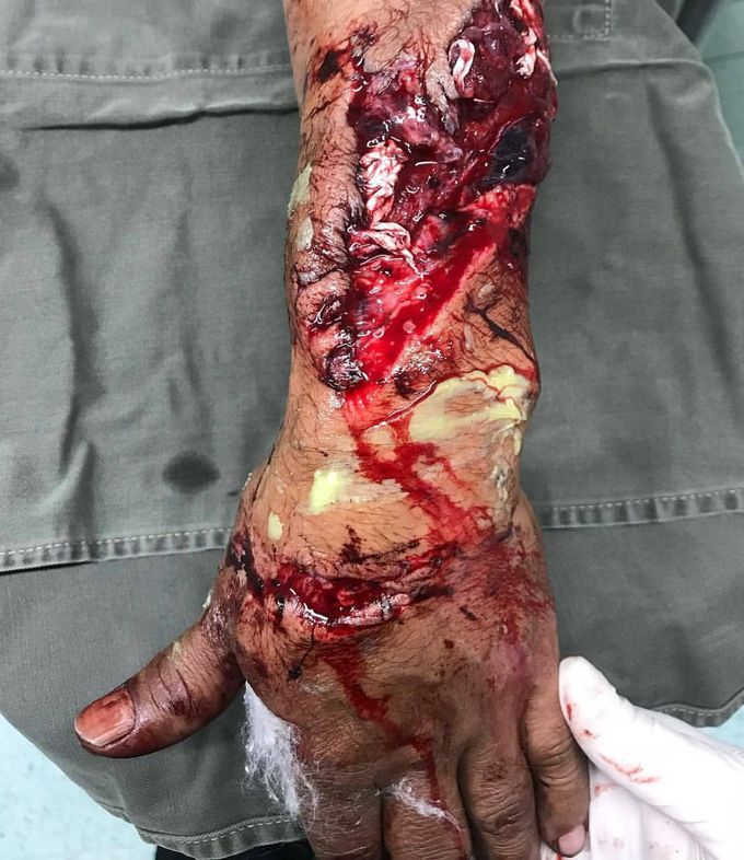 Power grinder accident 