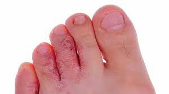 Athletes foot