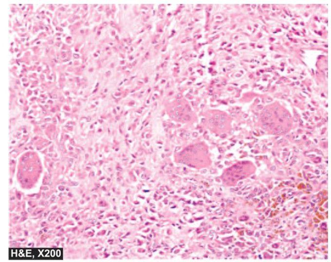 Tenosynovial giant cell tumour.