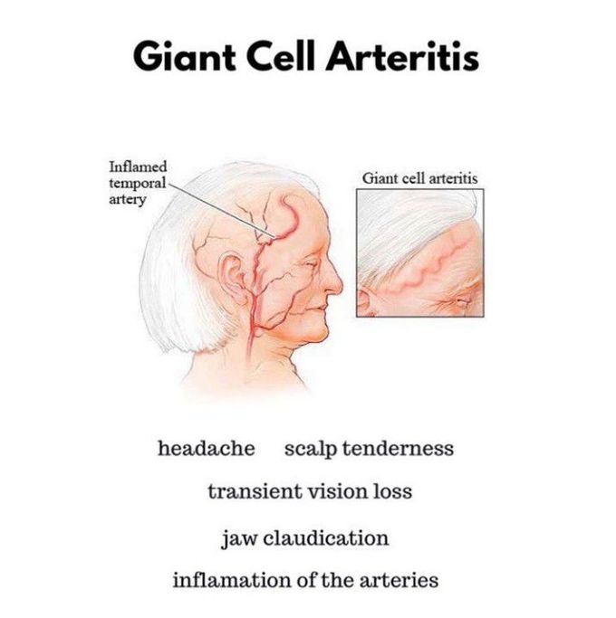 Giant Cell Arteritis