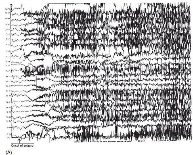 EEG during a epileptic seizure