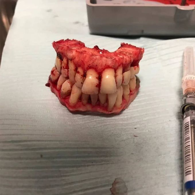 Ostectomy of maxillary and mandibular alveolar ridge, with removal of entire dentition - in preparation for full-mouth implants. 