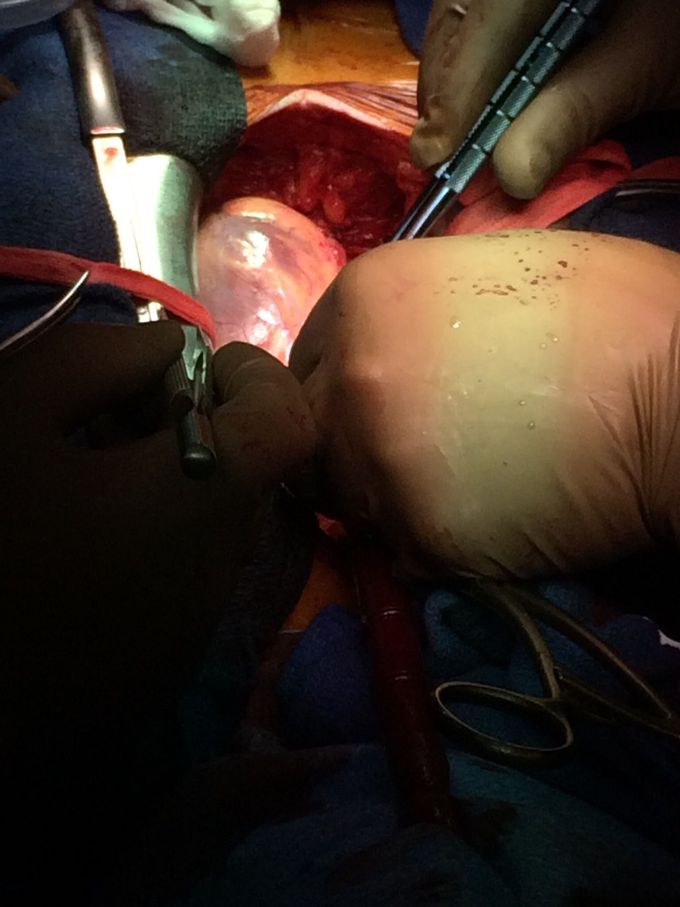 Aorte prothesis