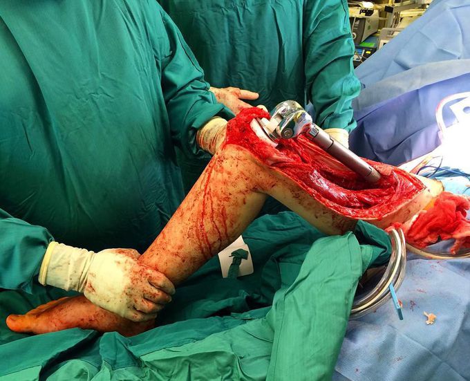 Total femur replacement surgery due to a chondrosarcoma - a metastatic bone cancer!