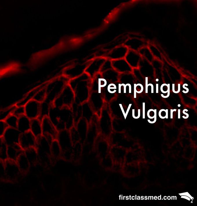 Pemphigus Vulgaris - A Dermatological Red Herring