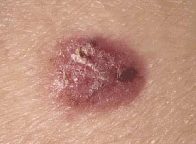 Basal cell carcinoma symptoms