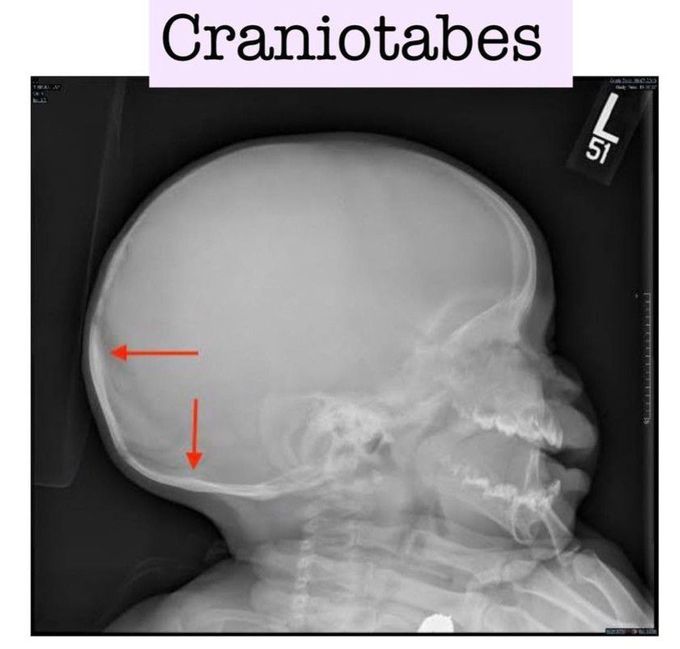 Craniotabes