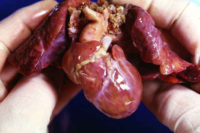 Hypoplastic right heart syndrome