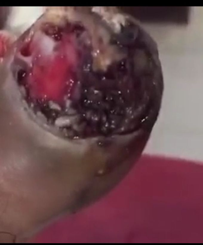 Maggots in great toe