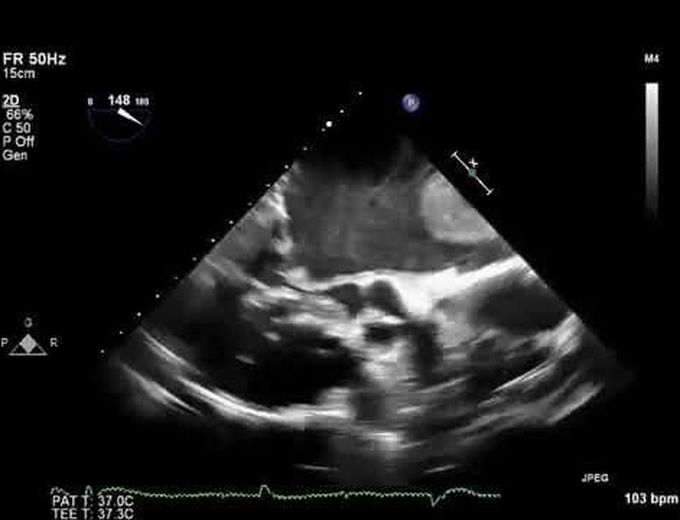 Mobile Large Left Atrial Thrombus