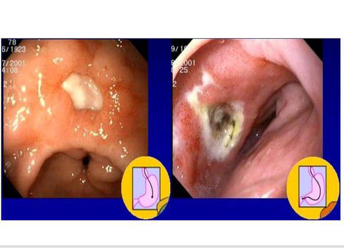 Peptic Ulcer