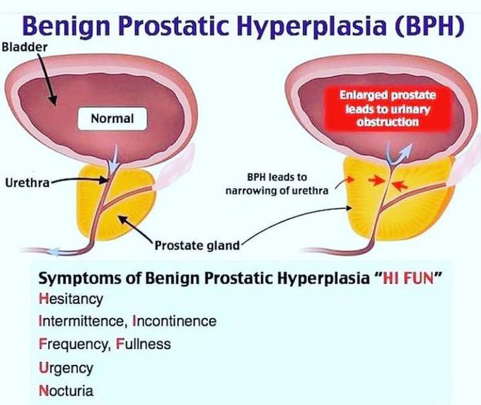 Benign prostate hyperplasia