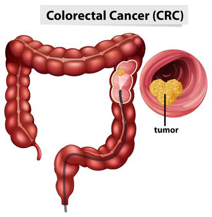 Colon cancer