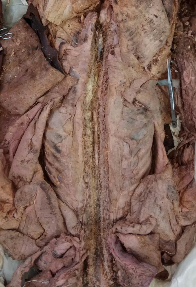 Laminectomy from occipital region
