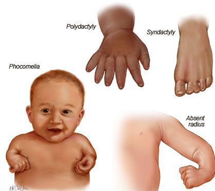 congenital limb deficiency