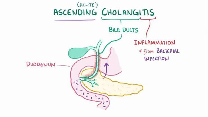 Cholangitis