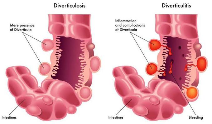 Diverticulosis vs diverticulitis