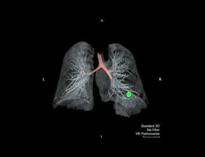 Robotic Right Lower Lobe Anteromedial Basilar (S7 + S8) Segmentectomy: A Case Report and Discussion