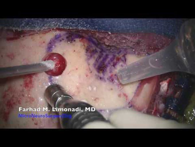 Meningioma : Brain surgery for removal of sphenoid wing meningioma (brain tumor)