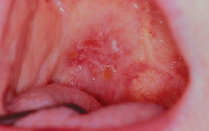 Mucous membrane pemphigoid
