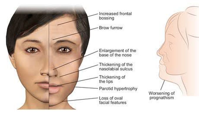 Acromegaly: symptoms