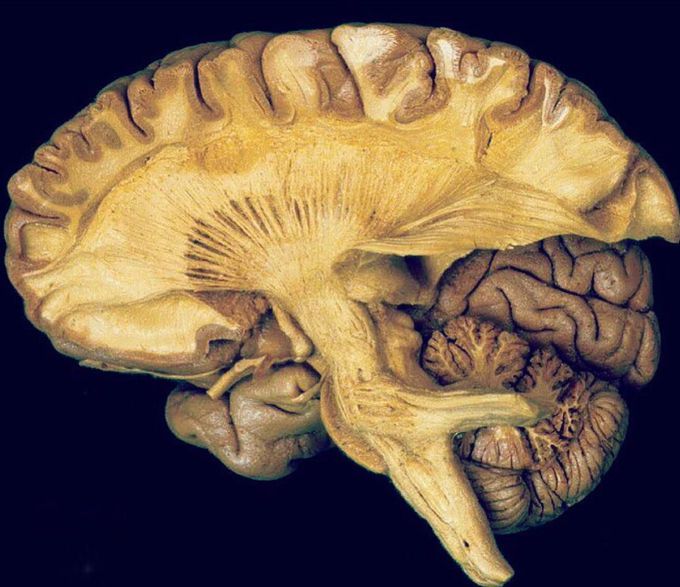 Brain dissection
