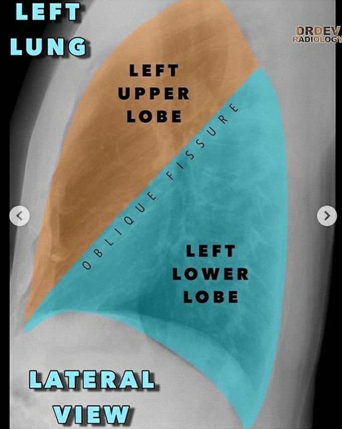 CXR last post