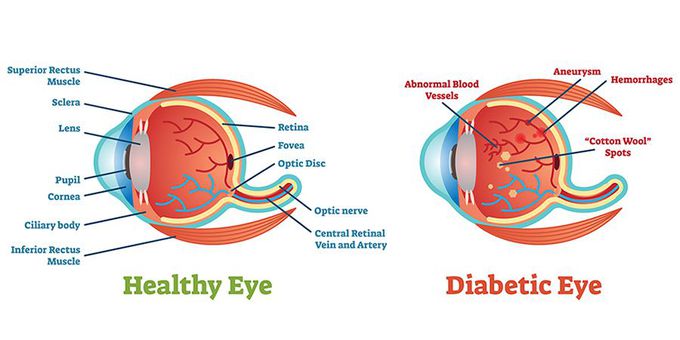Symptoms of Diabetic Retinopathy
