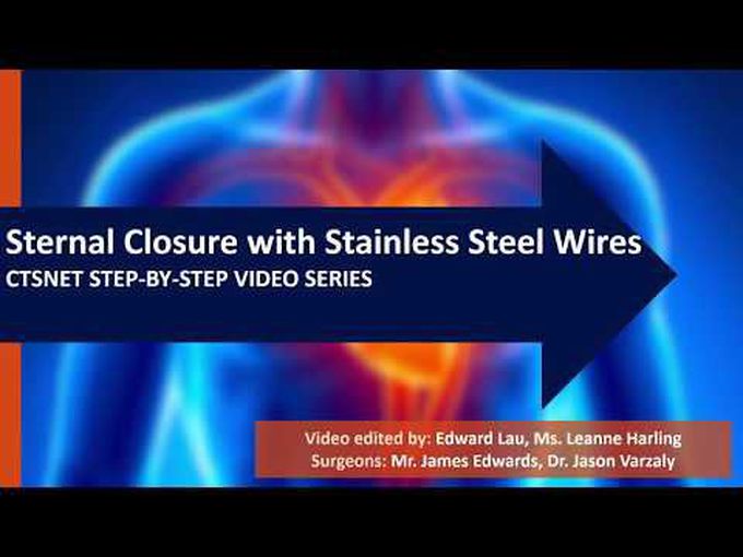 CTSNet Step-by-Step Series: Sternal Closure Using Stainless Steel Wires