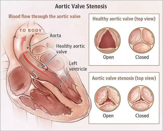 Aortic Stenosis