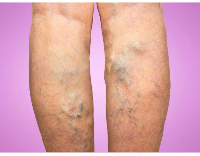 Varicose Veins
