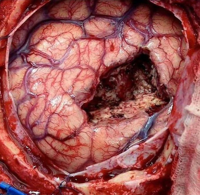 brain
