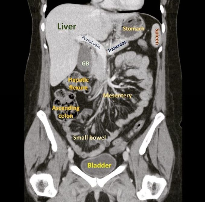 X ray abdomen erect