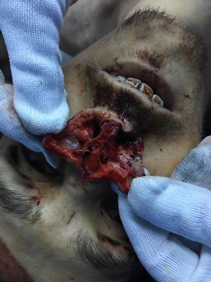 Car accident