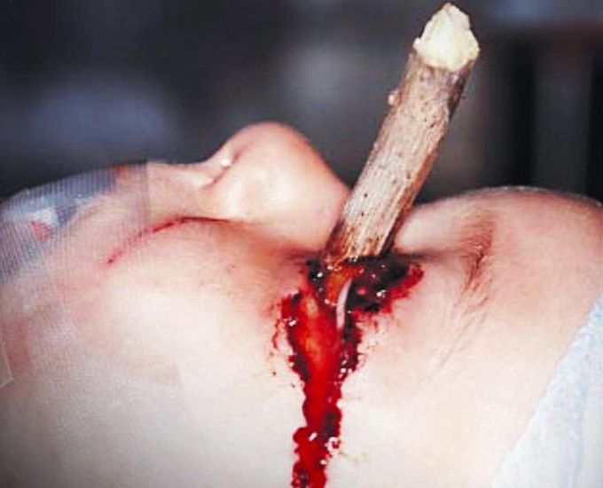 ⚠️❌Accident in the eye ❌⚠️