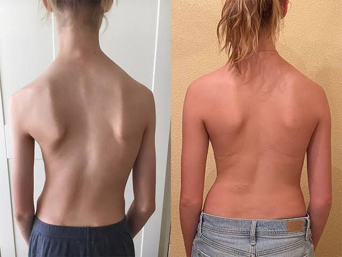 Scoliosis