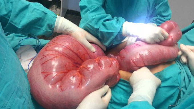 Megacolon