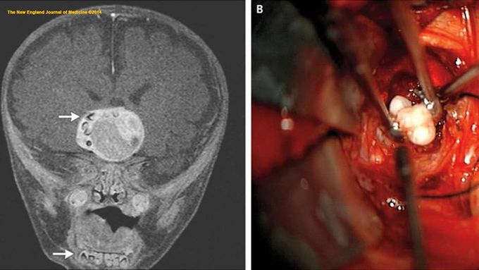 Toothy Brain Tumor