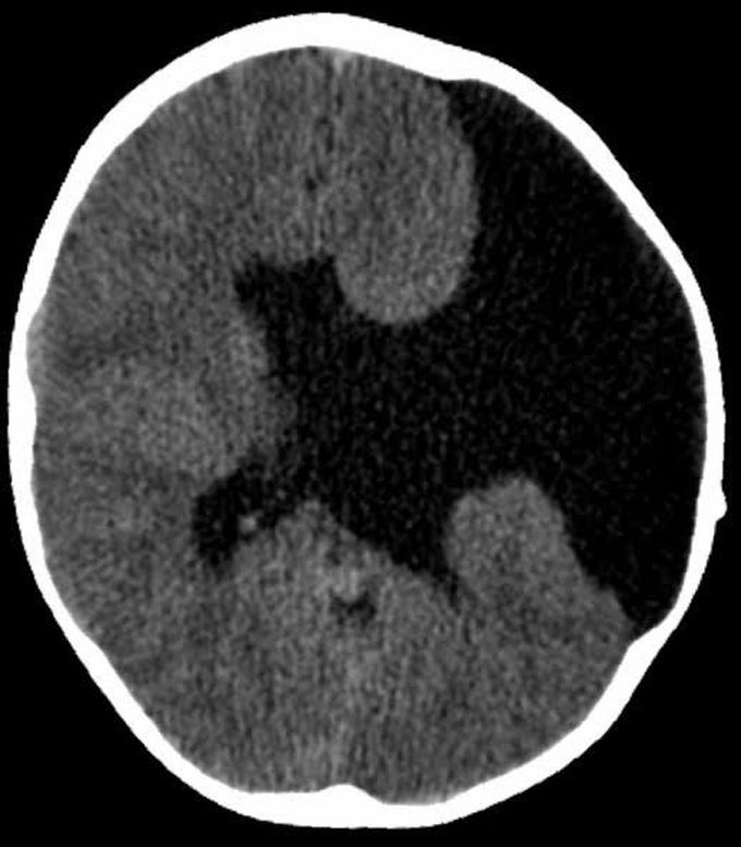 Schizencephaly