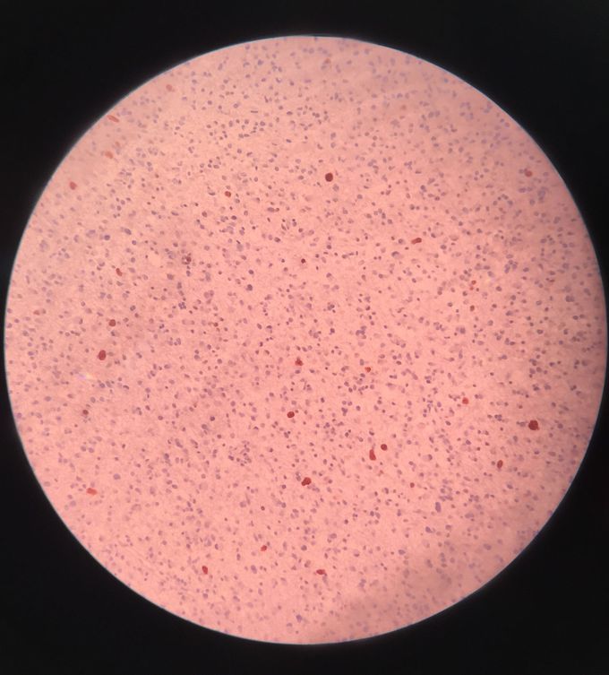 Astrocytoma diffusa (Immunohistochemistry marker Ki67)