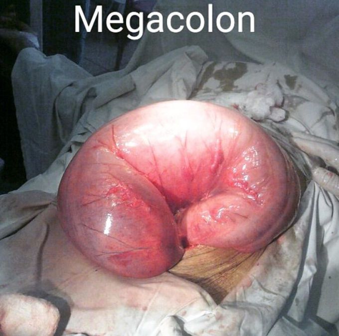 Megacolon! 😨