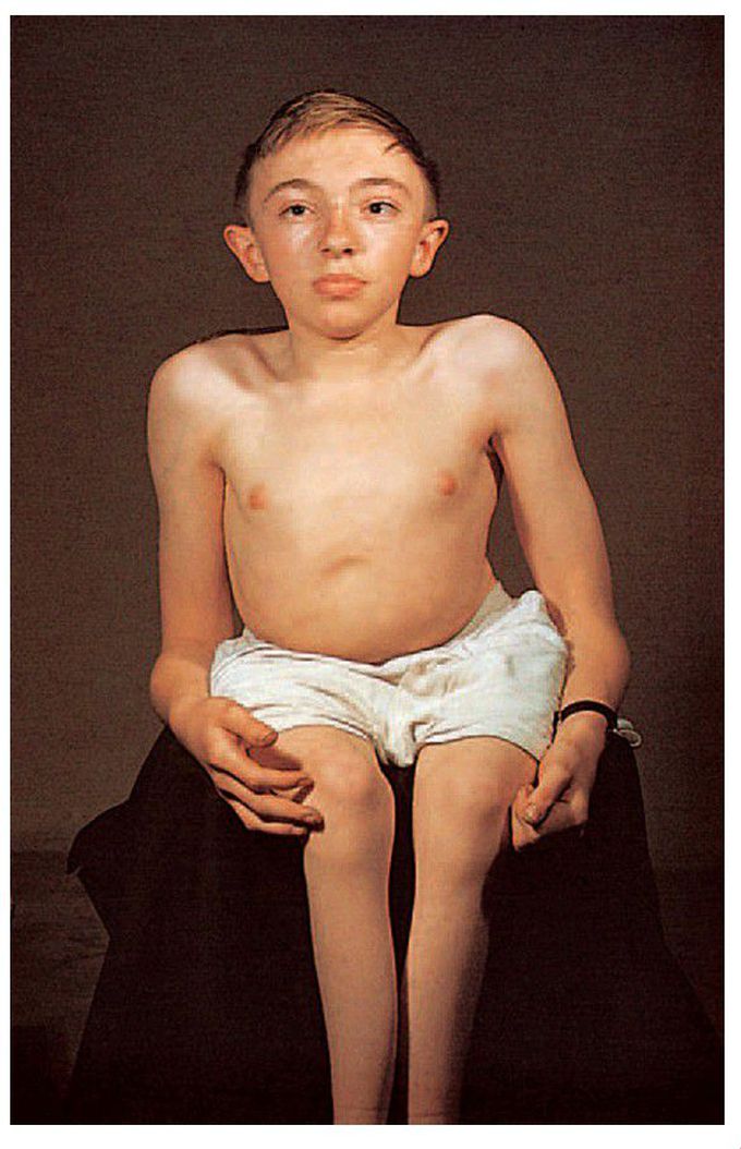 Osteogenesis imperfecta